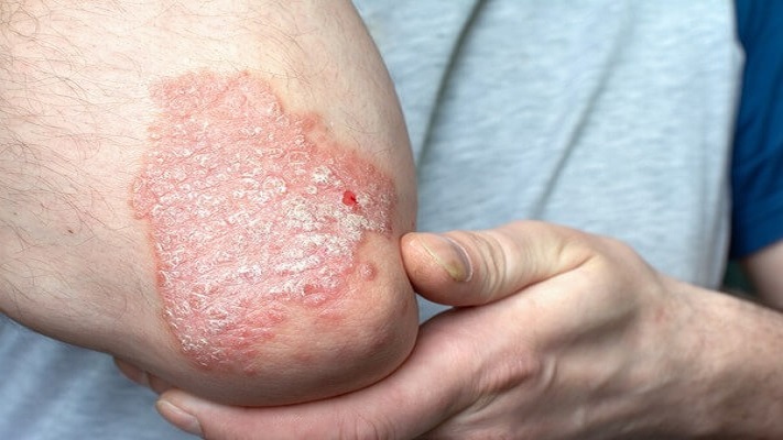 Brindarán una charla abierta y gratuita sobre enfermedad psoriática